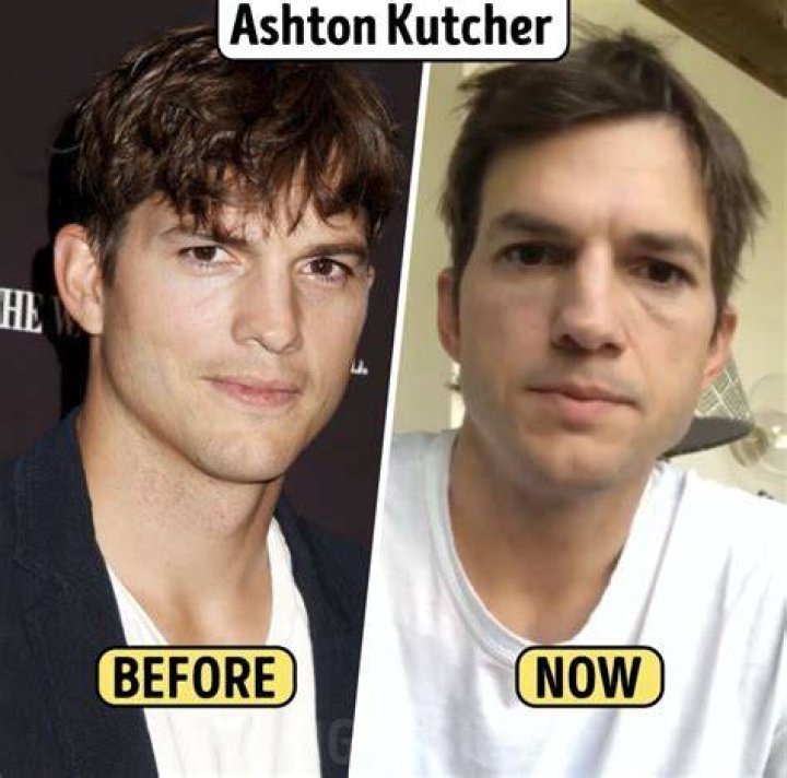 Ashton Kutcher Botox Then And Now- Did He Get A Nose Job?