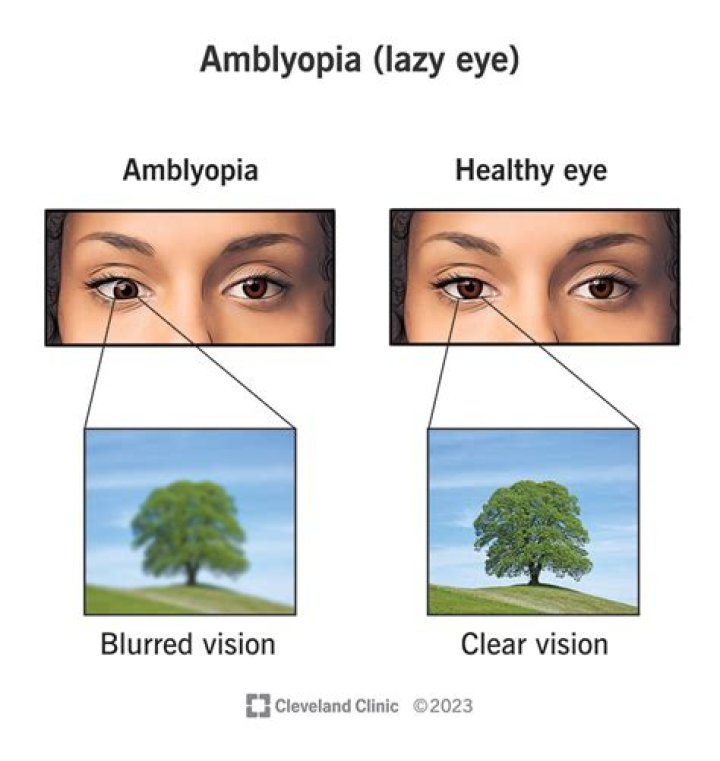 Mike Vrabel Eye Injury – Does He Have Amblyopia?