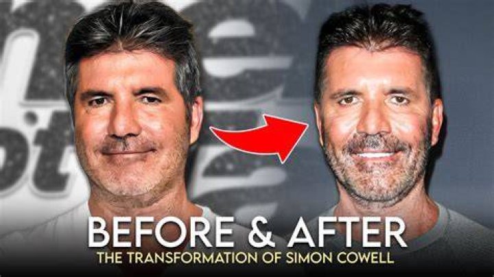What Happened To Simon Cowell’s Face? Fans Concerned With His Disappearing Eyes